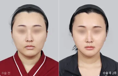Before & After