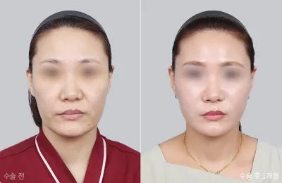 Before & After