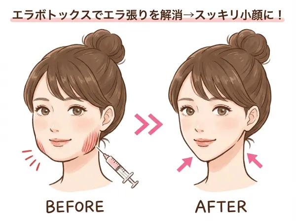 ボトックス注射の頻度・持続期間・長持ちさせるコツ、全部教えます