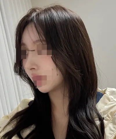 自家肋軟骨の鼻整形、大満足です >< ㅎㅎ