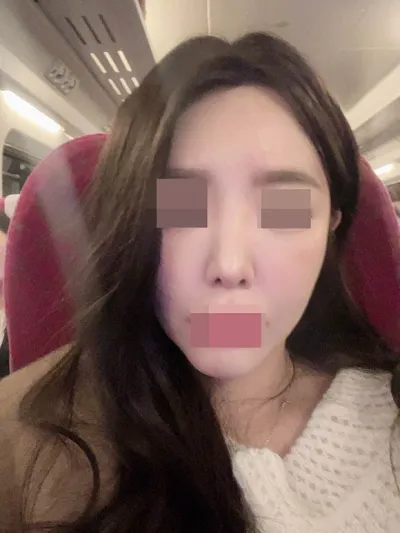 鼻の再手術を受けて自信もつきました :)