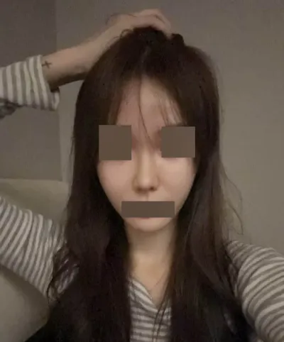 2回目の鼻の手術、ウォントで成功しました ^^