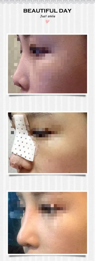 鼻の手術をして10日目！！