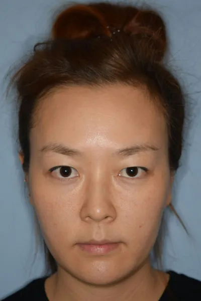 手術してからもう3ヶ月が経ちましたね。あちこち病院を念入りに調べたり、実際に行ってみたり、カウンセリングも受けてみたり…。でも、あまりピンとくるところはありませんでした。手術をしようという確信は五分五分だったので。失敗して副作用が出たり…。