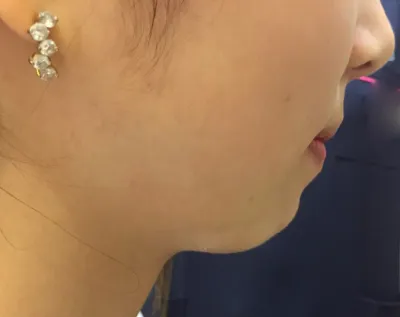 私は顎がかなり引っ込んでいるので、最初は顎先の矯正手術も考えていたのですが。