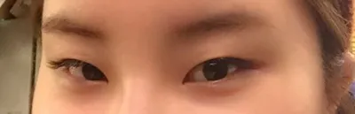 目頭切開しただけなのに、目がこんなに変わりました。