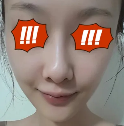 1ヶ月ほど前に脂肪移植をしたソンミです。皆さん、お元気ですか？