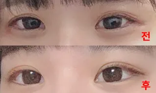 二重手術、成功しました