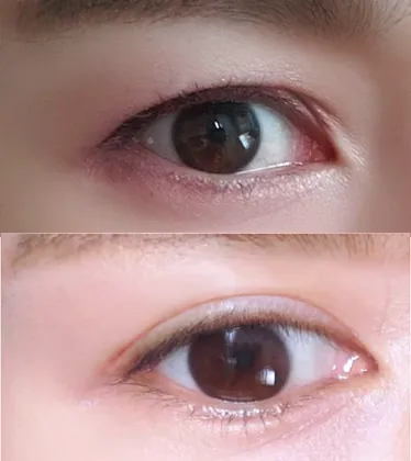 切開による目つき矯正に満足！