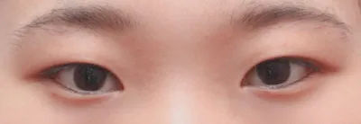 切開二重と目頭切開手術して一ヶ月