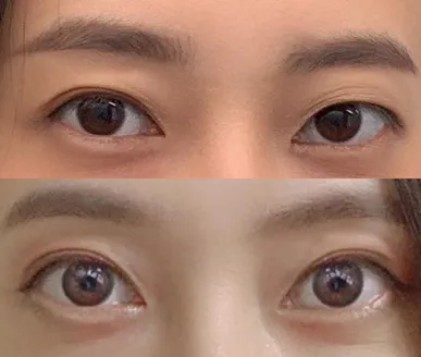 再手術6ヶ月目のレビュー