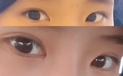 目頭切開、二重再手術2ヶ月後のレビューです～