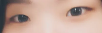 埋没二重と目頭切開のレビューです🥰