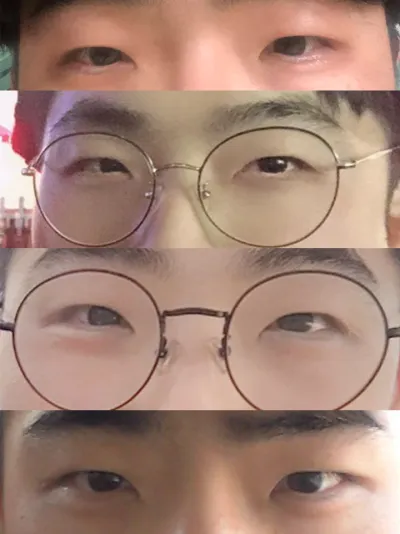 目つき矯正(切開)+目頭切開レビュー