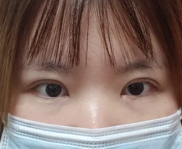 二重再手術、目頭切開の抜糸後のレビュー