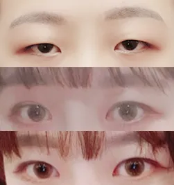 目つき矯正、目頭切開レビュー
