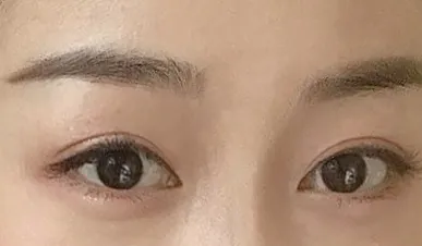 全切開＋目頭切開💖 念願の「派手めアウトライン」大成功だよ✌️✨