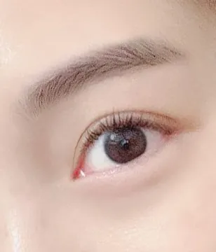 切開法での目つき矯正！！