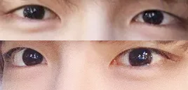 男の二重なし目つき矯正、目頭切開レビュー