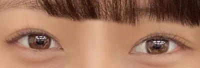 念願の二重整形✨ 病院選び迷子から脱出！ソヨンさんで人生変わった話🏥💖