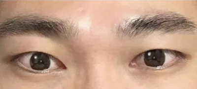 男の二重なし眼瞼下垂手術