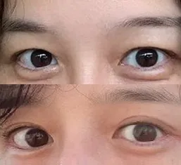 眉毛下切開手術の口コミ