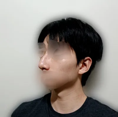 腫れがだんだん引いてきて、自然でありながらも鼻が洗練されて綺麗になったので、満足しています。