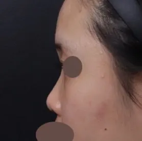 皆さん、ベリーグッド整形外科で鼻整形してください！