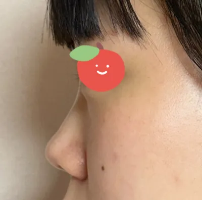 機能鼻整形ができるところを7ヶ所以上回りましたが、どこもできないと言われました。ですが、ベリーグッド整形外科では蓄膿症まで可能だと言ってくださり、説明も丁寧だったので契約しました。