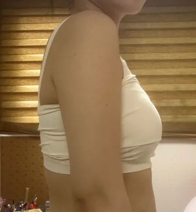 わあ…本当に腕の両サイドにあった脂肪がそぎ落とされましたね…！すごく満足していますㅠㅠㅠ