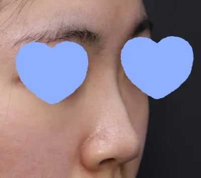 初めてカウンセリングに行ってすぐ、すごく気に入って手術の日程を決めて予約金まで払ってきちゃいました..^^