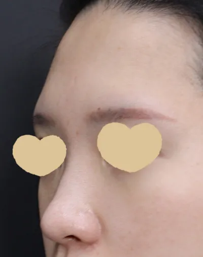 初めての鼻整形で選んだ病院は、モデルさんを見て一目惚れしたベリーグッド整形外科でした:)