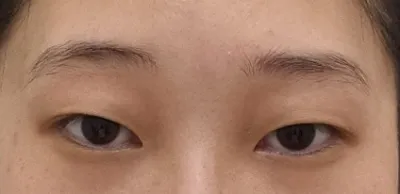 二重整形で悩んでいる方は、あちこち回らずにベリーグッド整形外科へカウンセリングに来てください(ⓐⓐ) °◇°