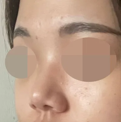 短い鼻と低い鼻筋がすごく気になって、手術することにしました！