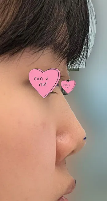 イム・ヨンミン院長を信じて手術を受けて本当によかったと思うので、とてもおすすめです！