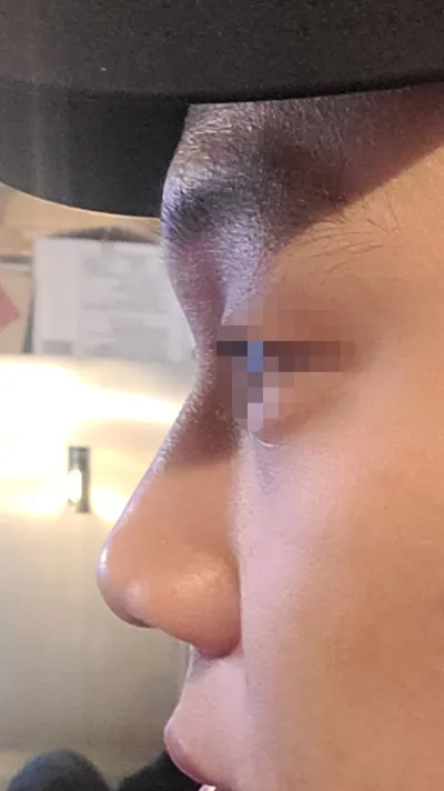 男性の鼻の整形が本当に上手です。ベリーグッド整形外科をおすすめします。