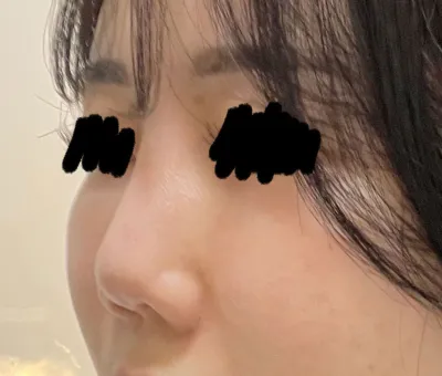 手術の結果は本当に大満足です。神の手…院長先生… ^^*