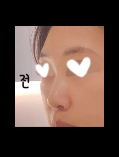 機能鼻整形をしてから4ヶ月目に入りました。笑