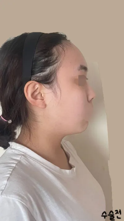 術後3ヶ月目のレビューです！