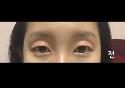 皆さん、目頭切開絶対してください😭