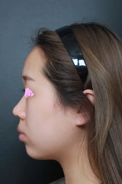 相談から手術まで丁寧にカウンセリングしてくださり、親切でとても良かったです(泣)