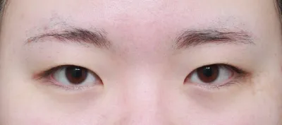 今回、一重だった私が目の整形（初整形）をしました。