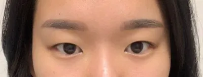 二重の大きな目がどうしても欲しくて、二重整形をすることにしました！