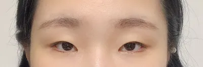 ついに待ちに待った二重整形しました。