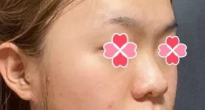 鼻の手術をしてから、全体的に印象が良くなったとよく言われます。笑