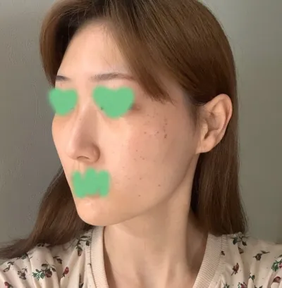 何年も抱えていたコンプレックスが数日でなくなって、とても良かったです。本当におすすめです！！