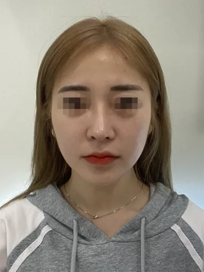 ボリュームが少し足りないと思って、フルフェイスで脂肪移植しました！