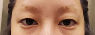 自然癒着をしてから1ヶ月ちょっと経ったのですが〜