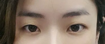 なぜ切開を考えたんだろうと思うほど、くっきりしていてすごく自然です！