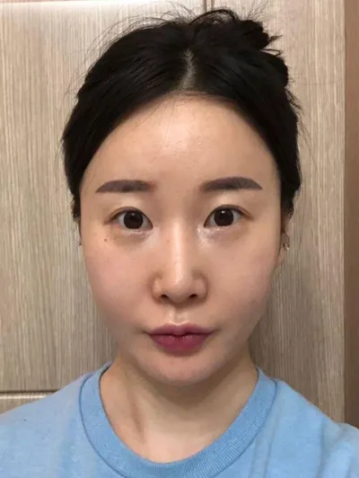 ベリーグッドで再手術してからもう3ヶ月目です！